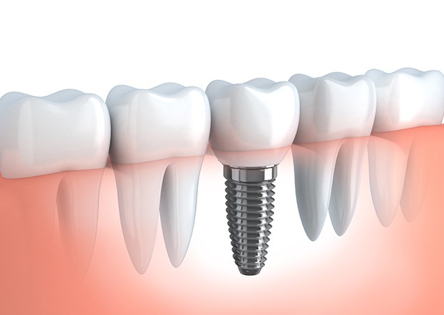 Dental Implant Crowns | Lume Dental | General & Family Dentist | Red Deer