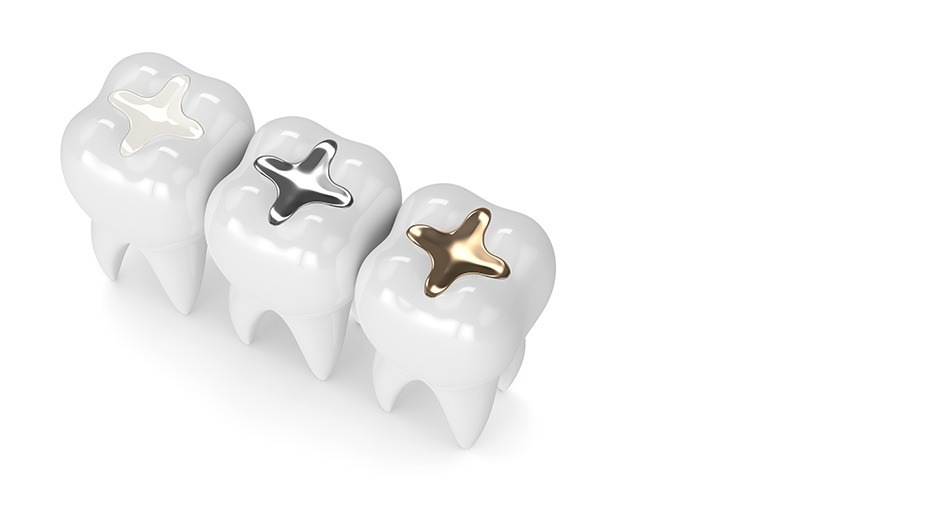 Gold Foil Fillings | Lume Dental | General & Family Dentist | Red Deer