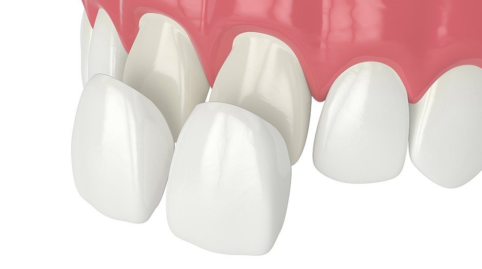 Porcelain Veneers | Lume Dental | General & Family Dentist | Red Deer