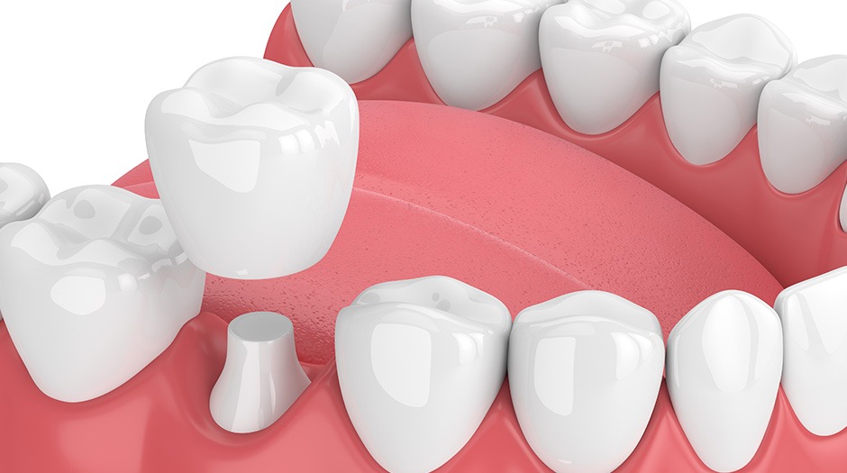 Dental Crowns | Lume Dental | General & Family Dentist | Red Deer