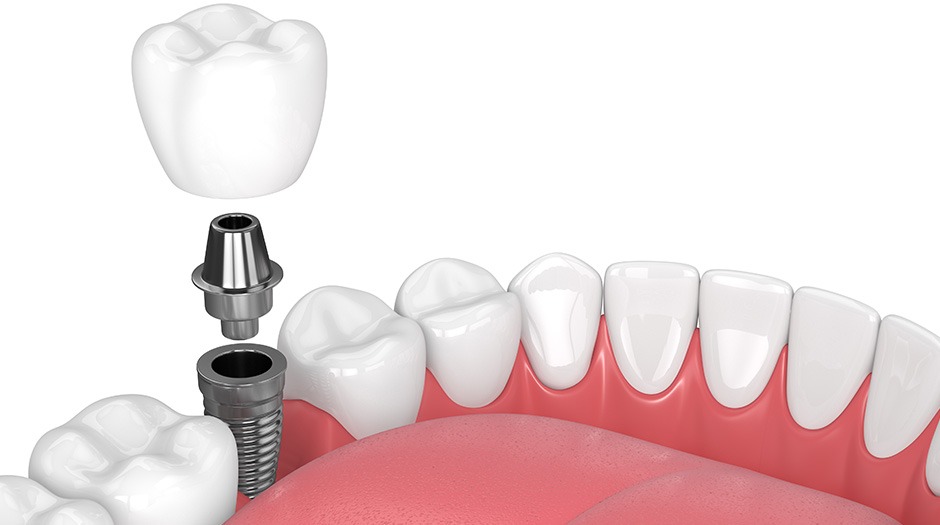 Dental Implants | Lume Dental | General & Family Dentist | Red Deer