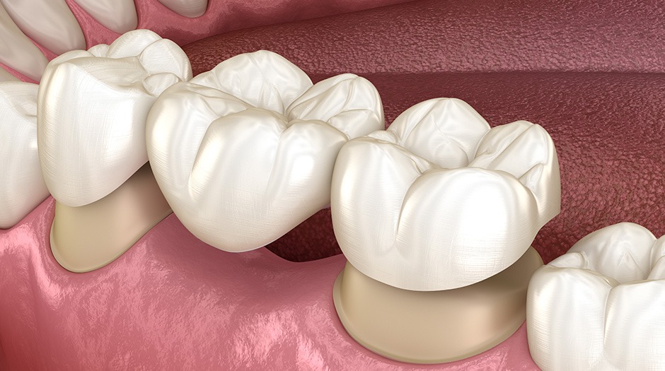 Dental Bridge | Lume Dental | General & Family Dentist | Red Deer