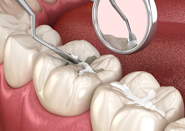 Dental Fillings | Lume Dental | General & Family Dentist | Red Deer