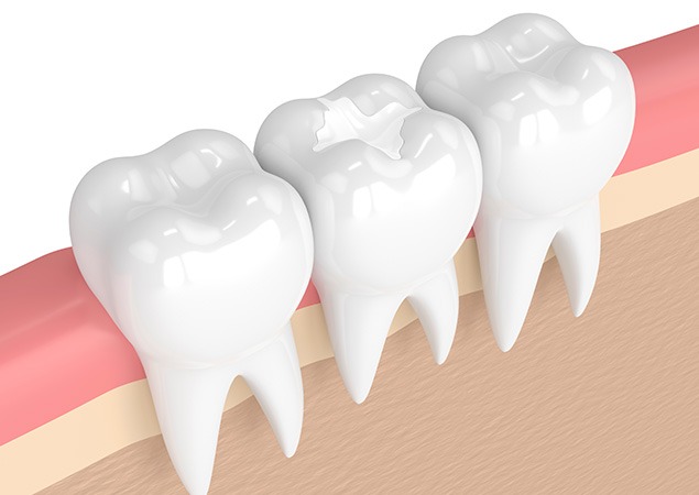 Tooth Coloured Match Fillings | Lume Dental | General & Family Dentist | Red Deer