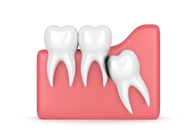 Wisdom Teeth Extractions | Lume Dental | General & Family Dentist | Red Deer